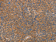 The image on the left is immunohistochemistry of paraffin-embedded Human liver cancer tissue using CSB-PA608726(PRKAA2 Antibody) at dilution 1/25, on the right is treated with fusion protein. (Original magnification: ×200)