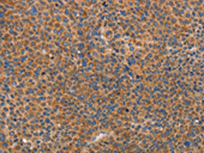 The image on the left is immunohistochemistry of paraffin-embedded Human liver cancer tissue using CSB-PA608726(PRKAA2 Antibody) at dilution 1/25, on the right is treated with fusion protein. (Original magnification: ×200)