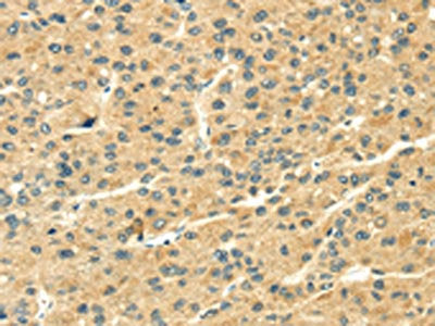 The image on the left is immunohistochemistry of paraffin-embedded Human liver cancer tissue using CSB-PA608850(THAP3 Antibody) at dilution 1/20, on the right is treated with synthetic peptide. (Original magnification: ×200)