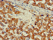 Immunohistochemistry of paraffin-embedded human liver cancer using CSB-PA610840LA01HU at dilution of 1:100