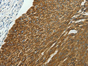 The image on the left is immunohistochemistry of paraffin-embedded Human cervical cancer tissue using CSB-PA611012(NDRG2 Antibody) at dilution 1/40, on the right is treated with synthetic peptide. (Original magnification: ×200)