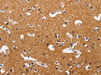 The image on the left is immunohistochemistry of paraffin-embedded Human brain tissue using CSB-PA611310(HK2 Antibody) at dilution 1/40, on the right is treated with fusion protein. (Original magnification: ×200)