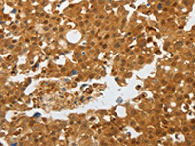 The image on the left is immunohistochemistry of paraffin-embedded Human breast cancer tissue using CSB-PA611485(AKAP8L Antibody) at dilution 1/25, on the right is treated with synthetic peptide. (Original magnification: ×200)