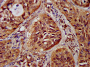IHC image of CSB-PA612121LA01HU diluted at 1:300 and staining in paraffin-embedded human cervical cancer performed on a Leica BondTM system. After dewaxing and hydration, antigen retrieval was mediated by high pressure in a citrate buffer (pH 6.0)...