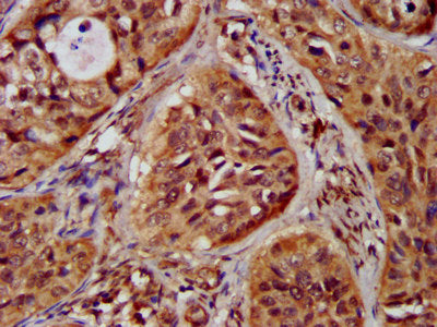 IHC image of CSB-PA612121LA01HU diluted at 1:300 and staining in paraffin-embedded human cervical cancer performed on a Leica BondTM system. After dewaxing and hydration, antigen retrieval was mediated by high pressure in a citrate buffer (pH 6.0)...