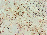 Immunohistochemistry of paraffin-embedded human breast cancer using CSB-PA613265ESR1HU at dilution of 1:100