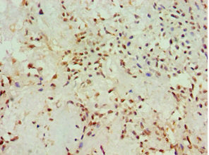 Immunohistochemistry of paraffin-embedded human breast cancer using CSB-PA613265ESR1HU at dilution of 1:100