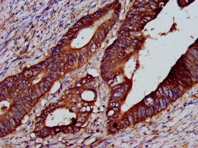 IHC image of CSB-PA613277LA01HU diluted at 1:200 and staining in paraffin-embedded human colon cancer performed on a Leica BondTM system. After dewaxing and hydration, antigen retrieval was mediated by high pressure in a citrate buffer (pH 6.0). S...