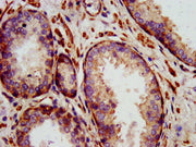 IHC image of CSB-PA613378LA01HU diluted at 1:1400 and staining in paraffin-embedded human prostate cancer performed on a Leica BondTM system. After dewaxing and hydration, antigen retrieval was mediated by high pressure in a citrate buffer (pH 6.0...