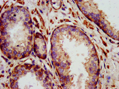IHC image of CSB-PA613378LA01HU diluted at 1:1400 and staining in paraffin-embedded human prostate cancer performed on a Leica BondTM system. After dewaxing and hydration, antigen retrieval was mediated by high pressure in a citrate buffer (pH 6.0...