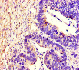 Immunohistochemistry of paraffin-embedded human ovarian cancer using CSB-PA613393LA01HU at dilution of 1:100