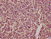 IHC image of CSB-PA613486NA01HU diluted at 1:300 and staining in paraffin-embedded human glioma performed on a Leica BondTM system. After dewaxing and hydration, antigen retrieval was mediated by high pressure in a citrate buffer (pH 6.0). Section...