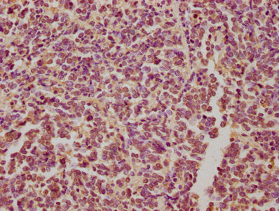 IHC image of CSB-PA613486NA01HU diluted at 1:300 and staining in paraffin-embedded human glioma performed on a Leica BondTM system. After dewaxing and hydration, antigen retrieval was mediated by high pressure in a citrate buffer (pH 6.0). Section...
