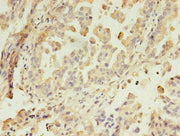 Immunohistochemistry of paraffin-embedded human lung cancer using CSB-PA613489LA01HU at dilution of 1:100