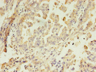 Immunohistochemistry of paraffin-embedded human lung cancer using CSB-PA613489LA01HU at dilution of 1:100