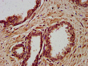 IHC image of CSB-PA613507LA01HU diluted at 1:400 and staining in paraffin-embedded human prostate cancer performed on a Leica BondTM system. After dewaxing and hydration, antigen retrieval was mediated by high pressure in a citrate buffer (pH 6.0)...