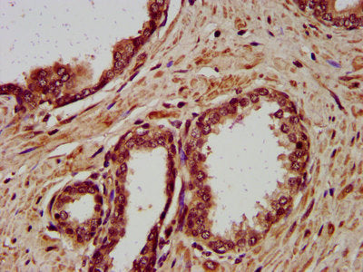 IHC image of CSB-PA613507LA01HU diluted at 1:400 and staining in paraffin-embedded human prostate cancer performed on a Leica BondTM system. After dewaxing and hydration, antigen retrieval was mediated by high pressure in a citrate buffer (pH 6.0)...