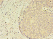 Immunohistochemistry of paraffin-embedded human gastric cancer using CSB-PA613538LA01HU at dilution of 1:100