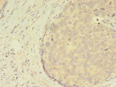 Immunohistochemistry of paraffin-embedded human gastric cancer using CSB-PA613538LA01HU at dilution of 1:100