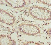 Immunohistochemistry of paraffin-embedded human colon cancer using CSB-PA613580ESR1HU at dilution of 1:100