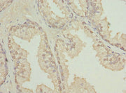 Immunohistochemistry of paraffin-embedded human prostate cancer using CSB-PA613603ESR2HU at dilution of 1:100