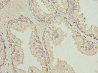 Immunohistochemistry of paraffin-embedded human prostate cancer using CSB-PA613603ESR2HU at dilution of 1:100