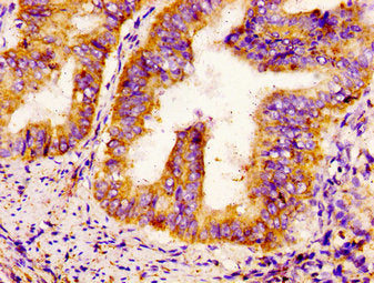 IHC image of CSB-PA613605LA01HU diluted at 1:300 and staining in paraffin-embedded human endometrial cancer performed on a Leica BondTM system. After dewaxing and hydration, antigen retrieval was mediated by high pressure in a citrate buffer (pH 6...