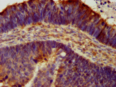 IHC image of CSB-PA613683LA01HU diluted at 1:300 and staining in paraffin-embedded human ovarian cancer performed on a Leica BondTM system. After dewaxing and hydration, antigen retrieval was mediated by high pressure in a citrate buffer (pH 6.0)....
