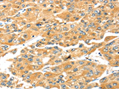 The image on the left is immunohistochemistry of paraffin-embedded Human liver cancer tissue using CSB-PA613772(SNAI3 Antibody) at dilution 1/25, on the right is treated with fusion protein. (Original magnification: ×200)