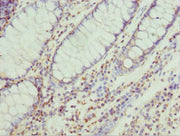 Immunohistochemistry of paraffin-embedded human colon cancer using CSB-PA614389ESR1HU at dilution of 1:100