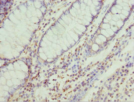 Immunohistochemistry of paraffin-embedded human colon cancer using CSB-PA614389ESR1HU at dilution of 1:100