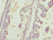 Immunohistochemistry of paraffin-embedded human prostate cancer using CSB-PA614389ESR2HU at dilution of 1:100