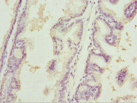 Immunohistochemistry of paraffin-embedded human prostate cancer using CSB-PA614389ESR2HU at dilution of 1:100