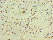 Immunohistochemistry of paraffin-embedded human breast cancer using CSB-PA614413ESR2HU at dilution of 1:100