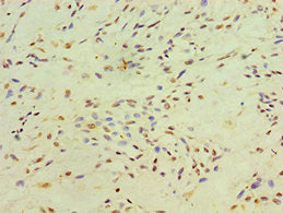 Immunohistochemistry of paraffin-embedded human breast cancer using CSB-PA614413ESR2HU at dilution of 1:100