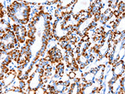 The image on the left is immunohistochemistry of paraffin-embedded Human thyroid cancer tissue using CSB-PA614749(ACAA2 Antibody) at dilution 1/20, on the right is treated with fusion protein. (Original magnification: ×200)