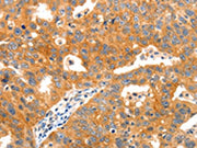 The image on the left is immunohistochemistry of paraffin-embedded Human ovarian cancer tissue using CSB-PA614772(PAFAH1B1 Antibody) at dilution 1/20, on the right is treated with synthetic peptide. (Original magnification: ×200)