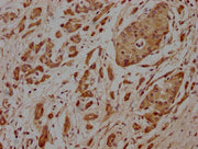 IHC image of CSB-PA614881LA01HU diluted at 1:100 and staining in paraffin-embedded human pancreatic cancer performed on a Leica BondTM system. After dewaxing and hydration, antigen retrieval was mediated by high pressure in a citrate buffer (pH 6....