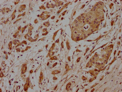 IHC image of CSB-PA614881LA01HU diluted at 1:100 and staining in paraffin-embedded human pancreatic cancer performed on a Leica BondTM system. After dewaxing and hydration, antigen retrieval was mediated by high pressure in a citrate buffer (pH 6....