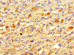 Immunohistochemistry of paraffin-embedded human melanoma using CSB-PA614893LA01HU at dilution of 1:100