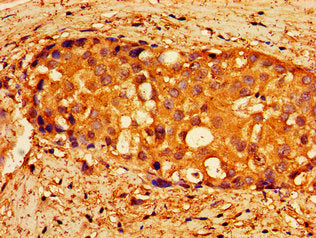 Immunohistochemistry of paraffin-embedded human breast cancer using CSB-PA614901LA01HU at dilution of 1:100