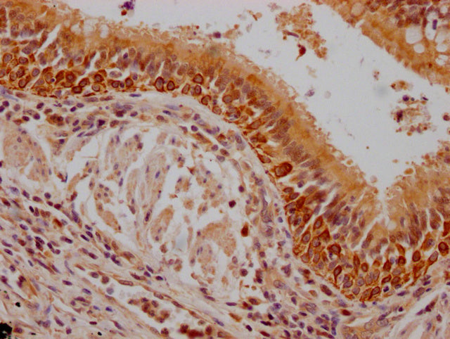 IHC image of CSB-PA614990LA01HU diluted at 1:200 and staining in paraffin-embedded human lung cancer performed on a Leica BondTM system. After dewaxing and hydration, antigen retrieval was mediated by high pressure in a citrate buffer (pH 6.0). Se...