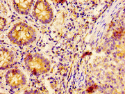 IHC image of CSB-PA615539LA01HU diluted at 1:400 and staining in paraffin-embedded human colon cancer performed on a Leica BondTM system. After dewaxing and hydration, antigen retrieval was mediated by high pressure in a citrate buffer (pH 6.0). S...