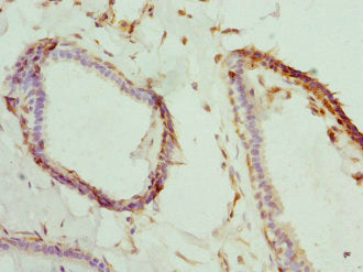 Immunohistochemistry of paraffin-embedded human breast cancer using CSB-PA615541DSR1HU at dilution of 1:100