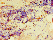 Immunohistochemistry of paraffin-embedded human breast cancer using CSB-PA615663ESR2HU at dilution of 1:100