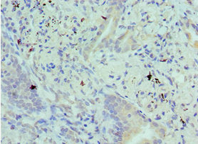 Immunohistochemistry of paraffin-embedded human lung cancer using CSB-PA615677ESR2HU at dilution of 1:100