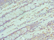 Immunohistochemistry of paraffin-embedded human colon cancer using CSB-PA615687DSR2HU at dilution of 1:100