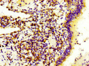 IHC image of CSB-PA615717LA01HU diluted at 1:300 and staining in paraffin-embedded human lung cancer performed on a Leica BondTM system. After dewaxing and hydration, antigen retrieval was mediated by high pressure in a citrate buffer (pH 6.0). Se...