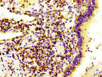 IHC image of CSB-PA615717LA01HU diluted at 1:300 and staining in paraffin-embedded human lung cancer performed on a Leica BondTM system. After dewaxing and hydration, antigen retrieval was mediated by high pressure in a citrate buffer (pH 6.0). Se...