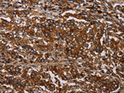 The image on the left is immunohistochemistry of paraffin-embedded Human liver cancer tissue using CSB-PA615826(MAGEC2 Antibody) at dilution 1/40, on the right is treated with synthetic peptide. (Original magnification: ×200)